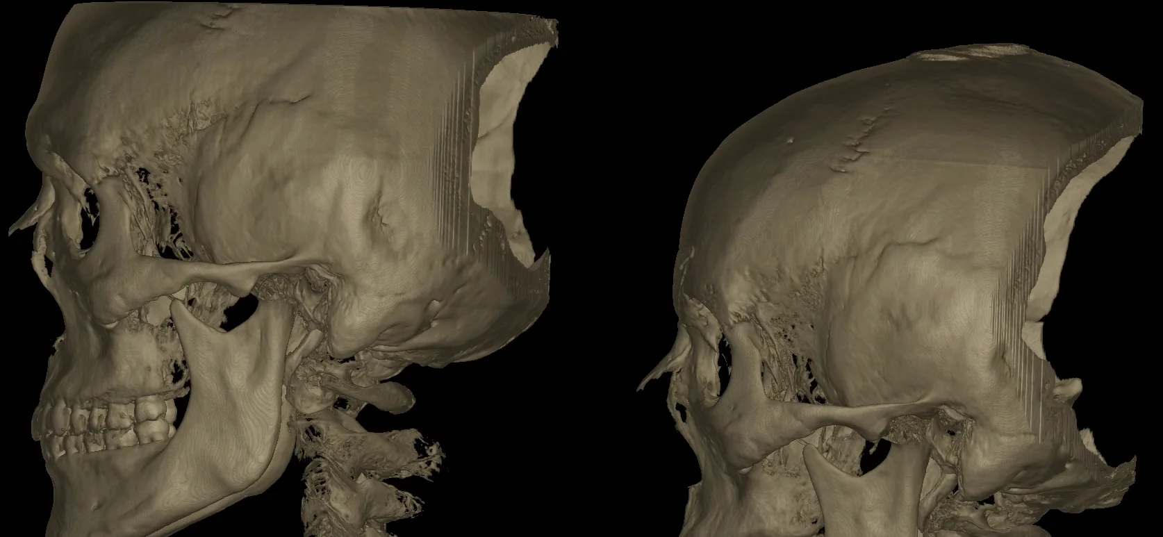 3D CT side view of a forehead before and after Type III reconstruction, with the anterior wall of the frontal sinus set back