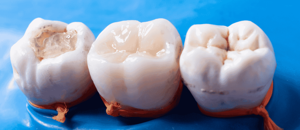 Tooth-Colored Composite Fillings