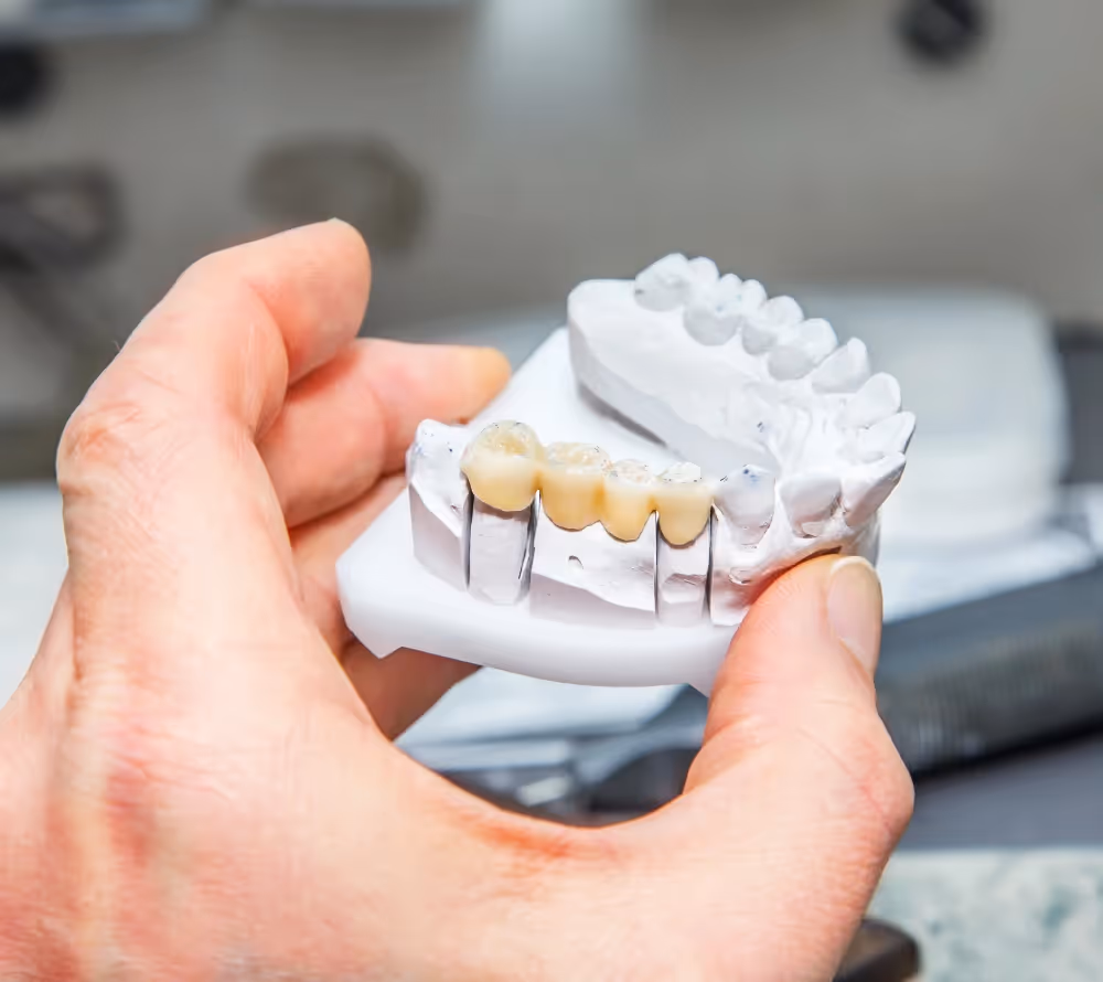 Dental bridges