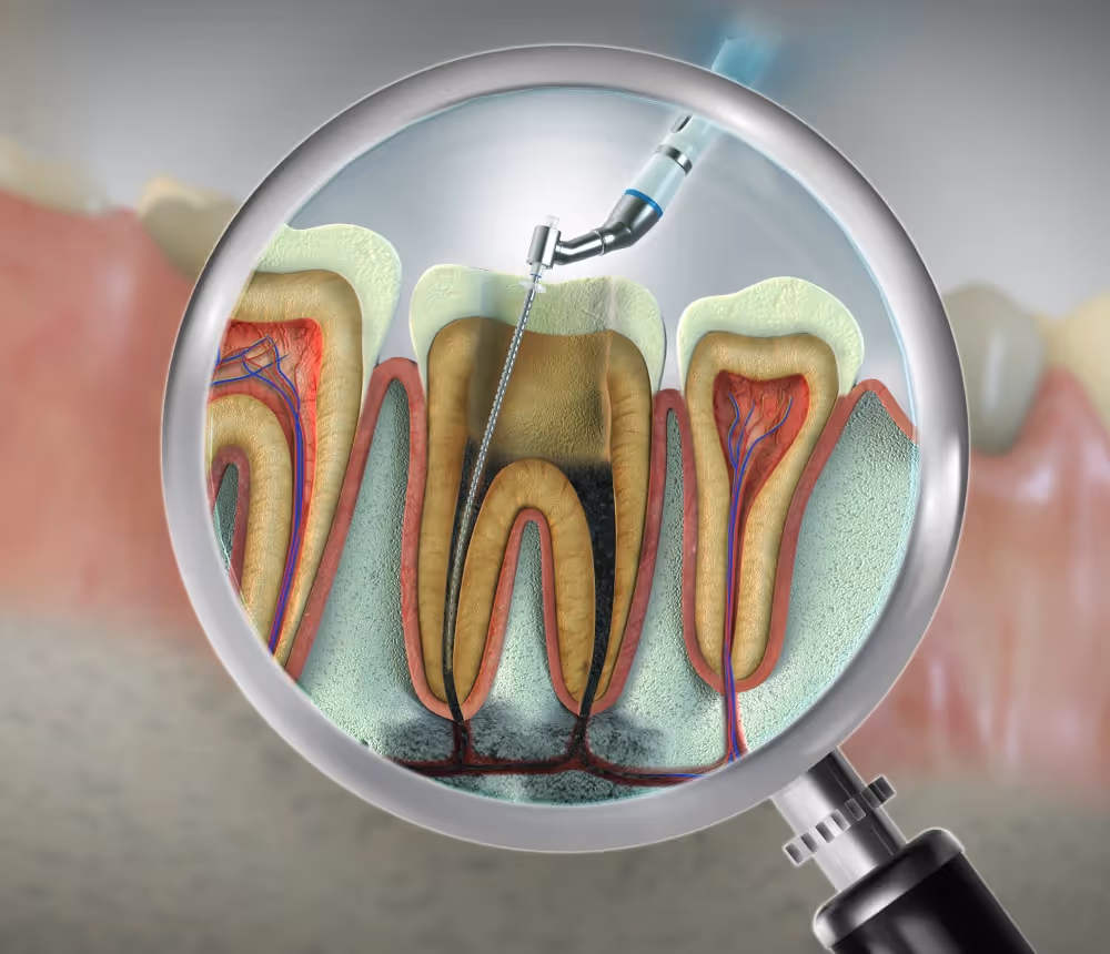 Root canal therapy