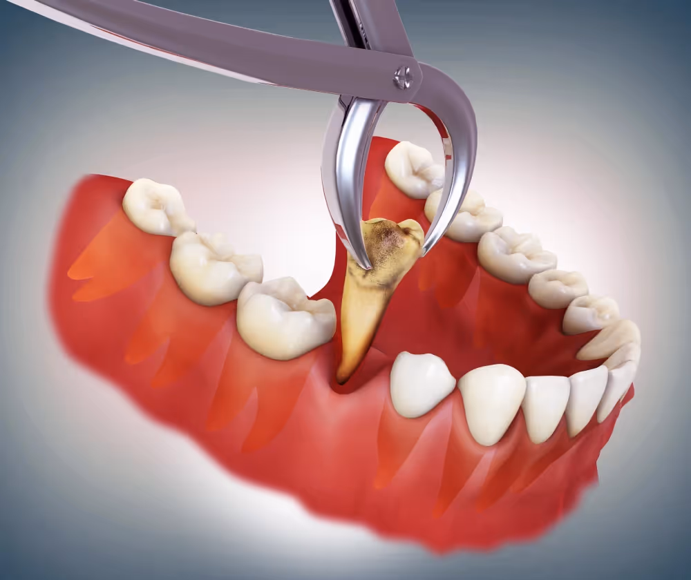 Extractions