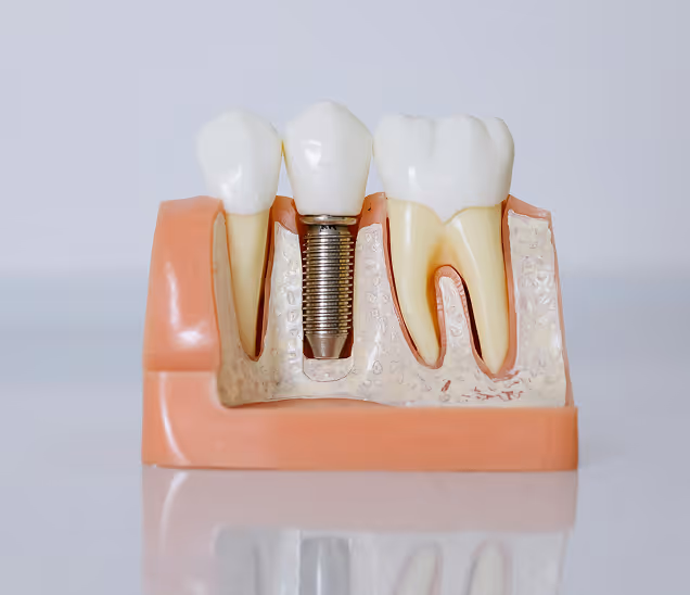 Single tooth implants