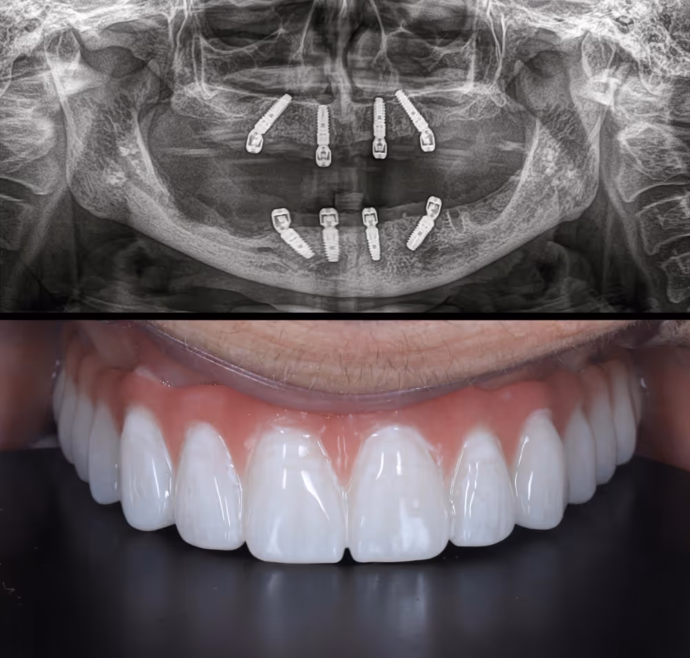 Full arch implants