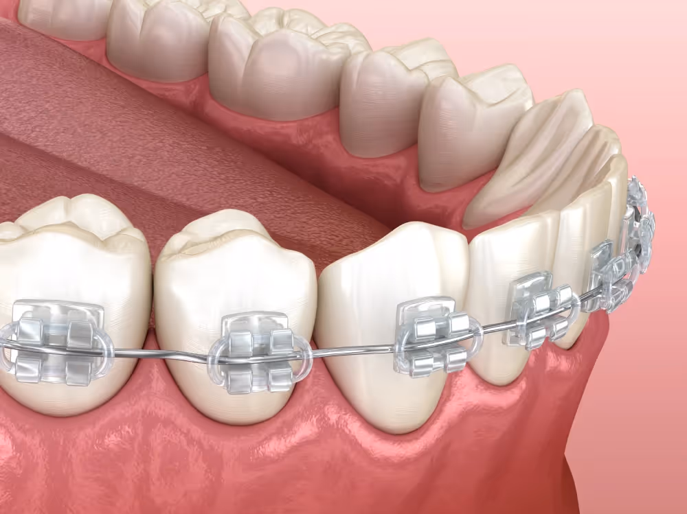 Ceramic braces