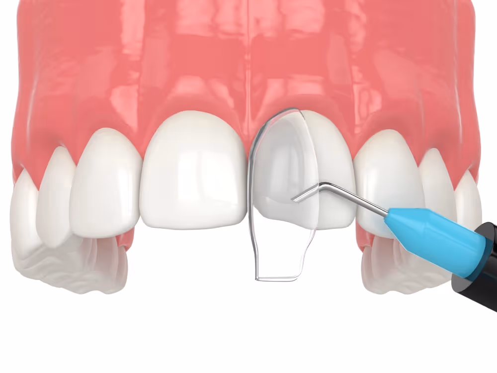 Cosmetic bonding