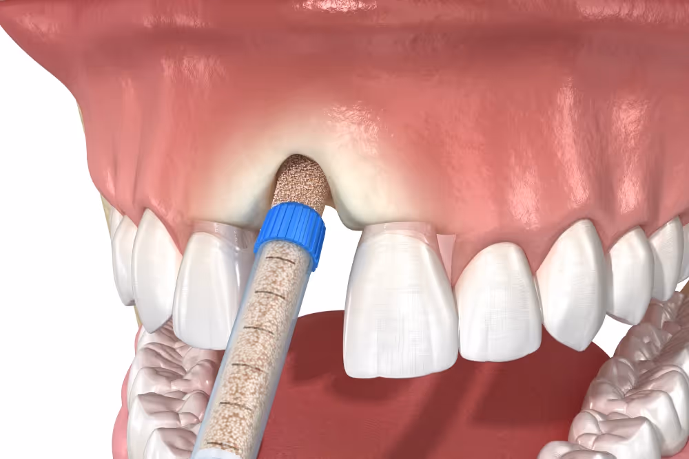 Bone grafting