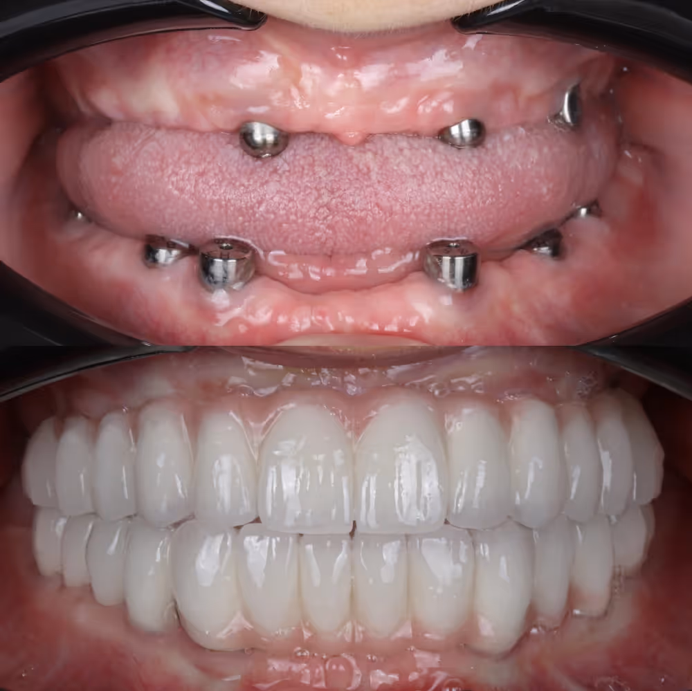 Fixed full arch implants