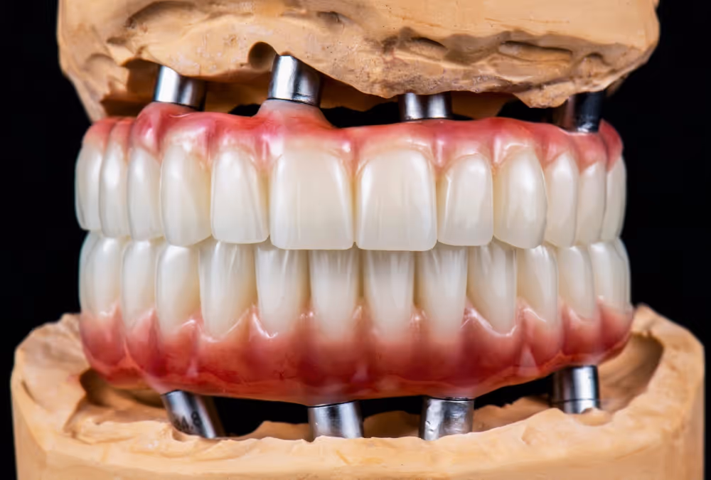 Full arch implants