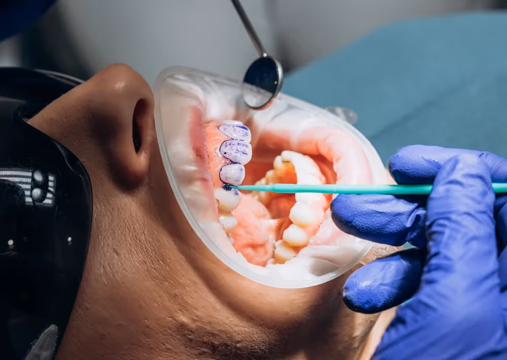 Fluoride treatments