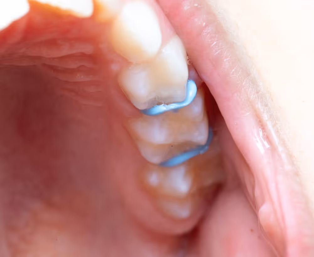 Dental sealants