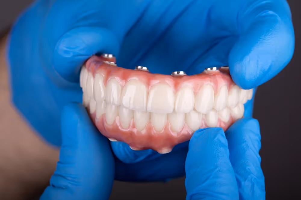 Implant-supported dentures