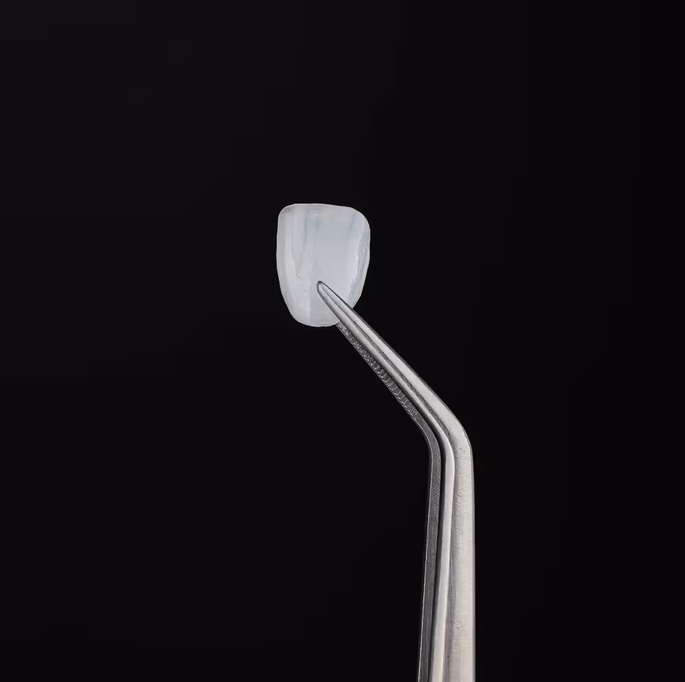No-prep veneers