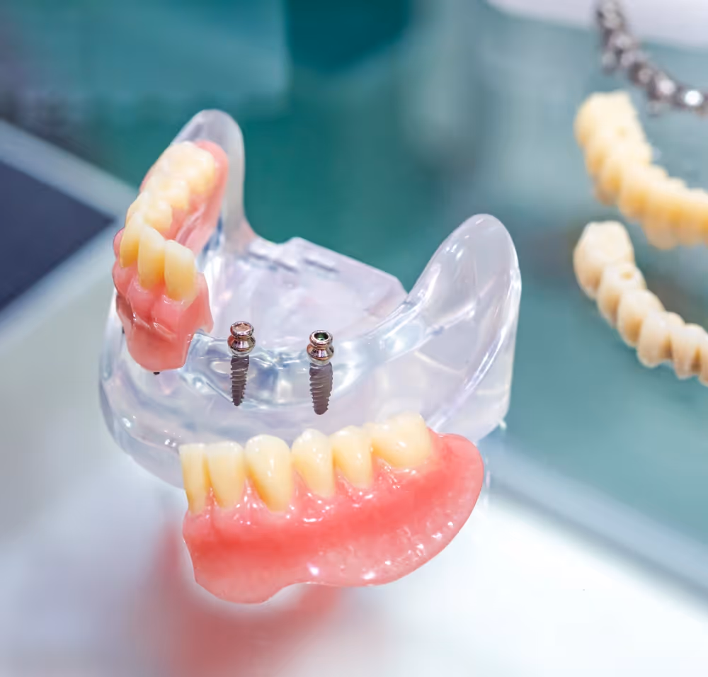 Mini implants