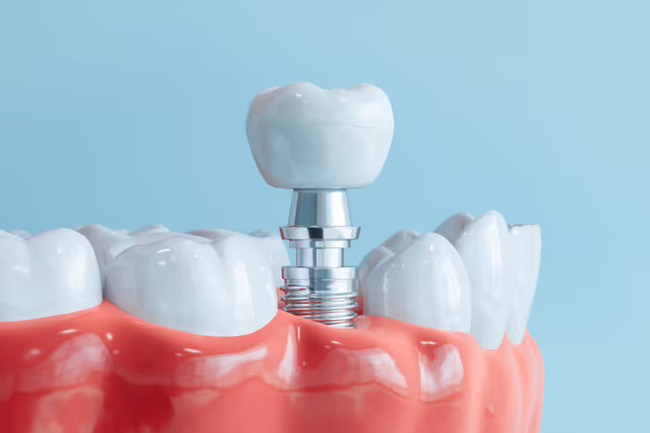 Close-up of a dental implant model showing a metal implant screw and attached tooth crown in gum tissue among natural teeth.
