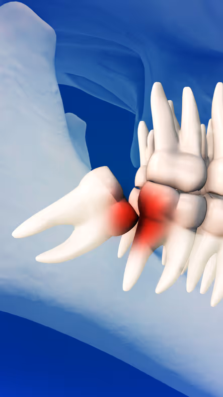 3D illustration of an impacted wisdom tooth pressing against adjacent teeth with red inflammation highlights.
