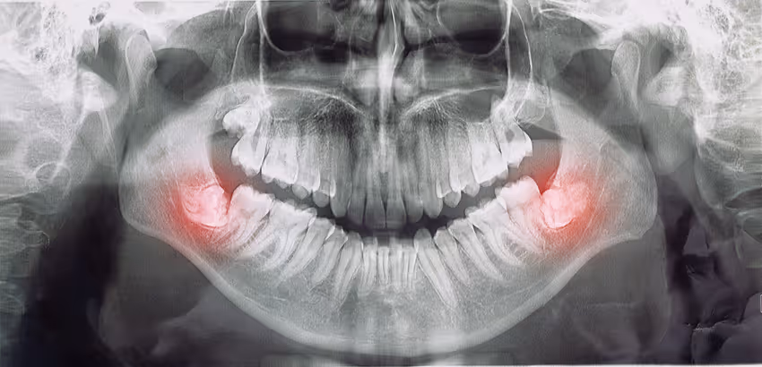 Panoramic dental X-ray highlighting impacted wisdom teeth on both lower jaw sides.