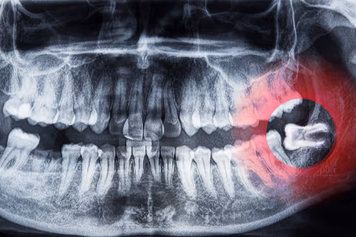 Dental X-ray showing wisdom teeth with the lower right wisdom tooth impacted and highlighted in red.