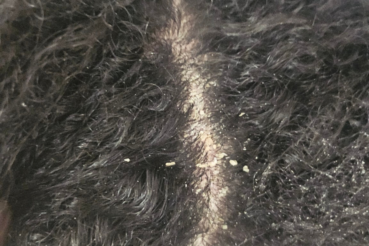 Pellicules épaisses visibls sur cuir chevelu de cheveux crépus texturés