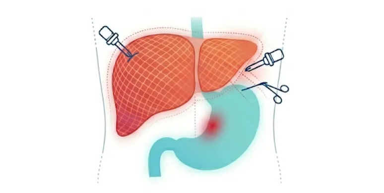 Illustration of surgical tools targeting the liver and stomach area, showing a depiction of a laparoscopic procedure with instruments inserted into the abdomen.