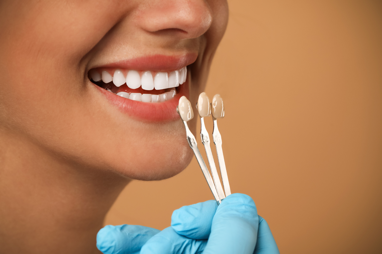 CEREC - Same Day Crowns