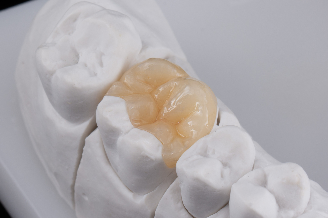 Dental Inlays
