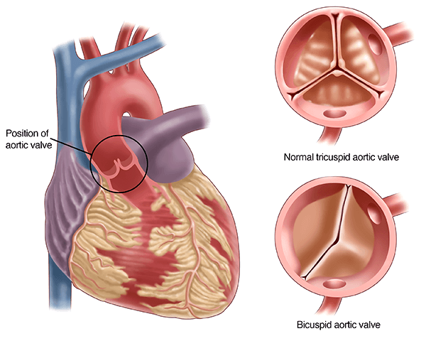 bicuspid aortic valve children London