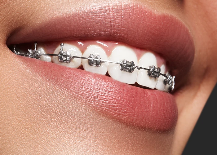 Close-up of a smiling mouth with metal braces on clean white teeth.
