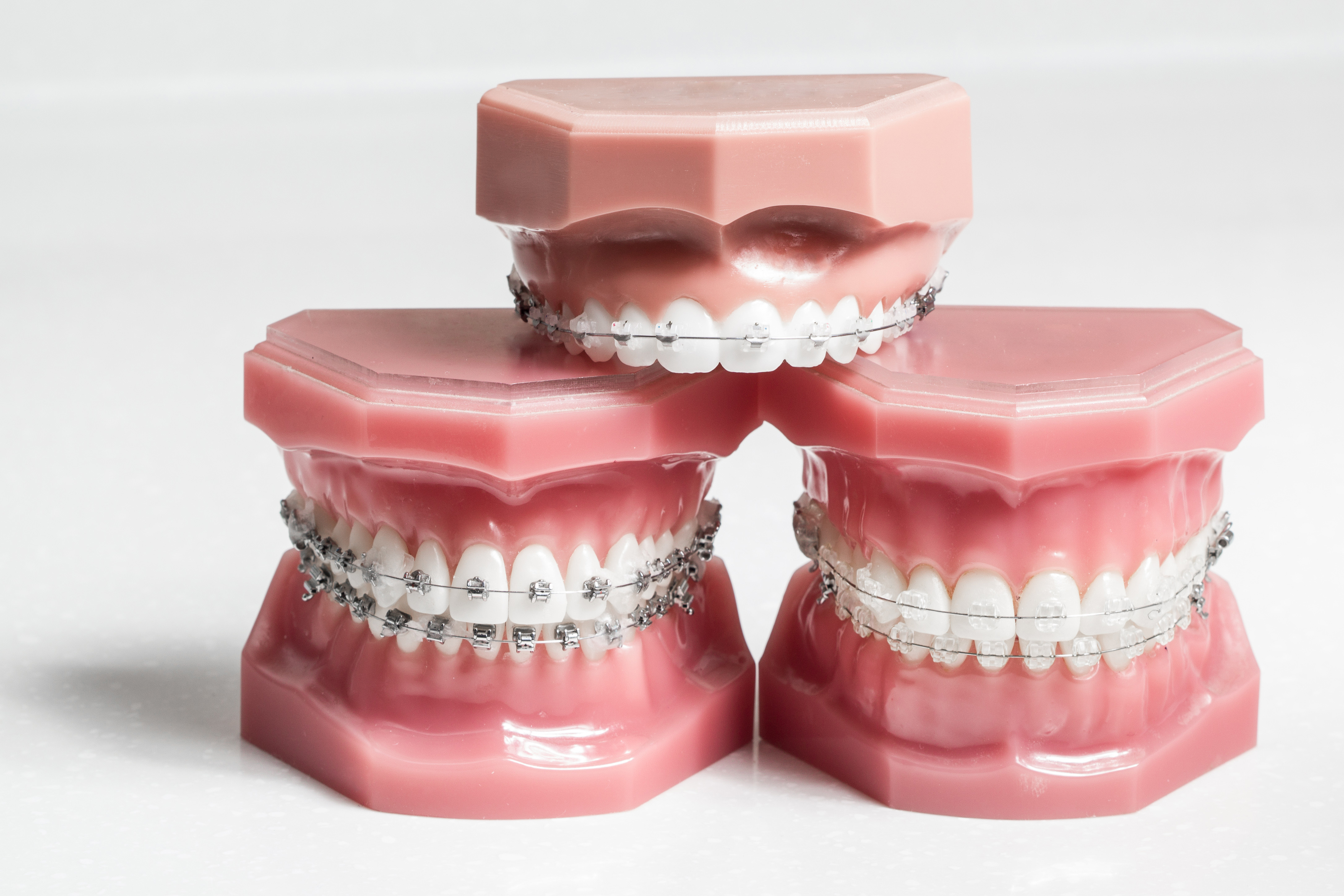 Three dental models showing different types of braces on teeth: metal, ceramic, and clear aligner style.