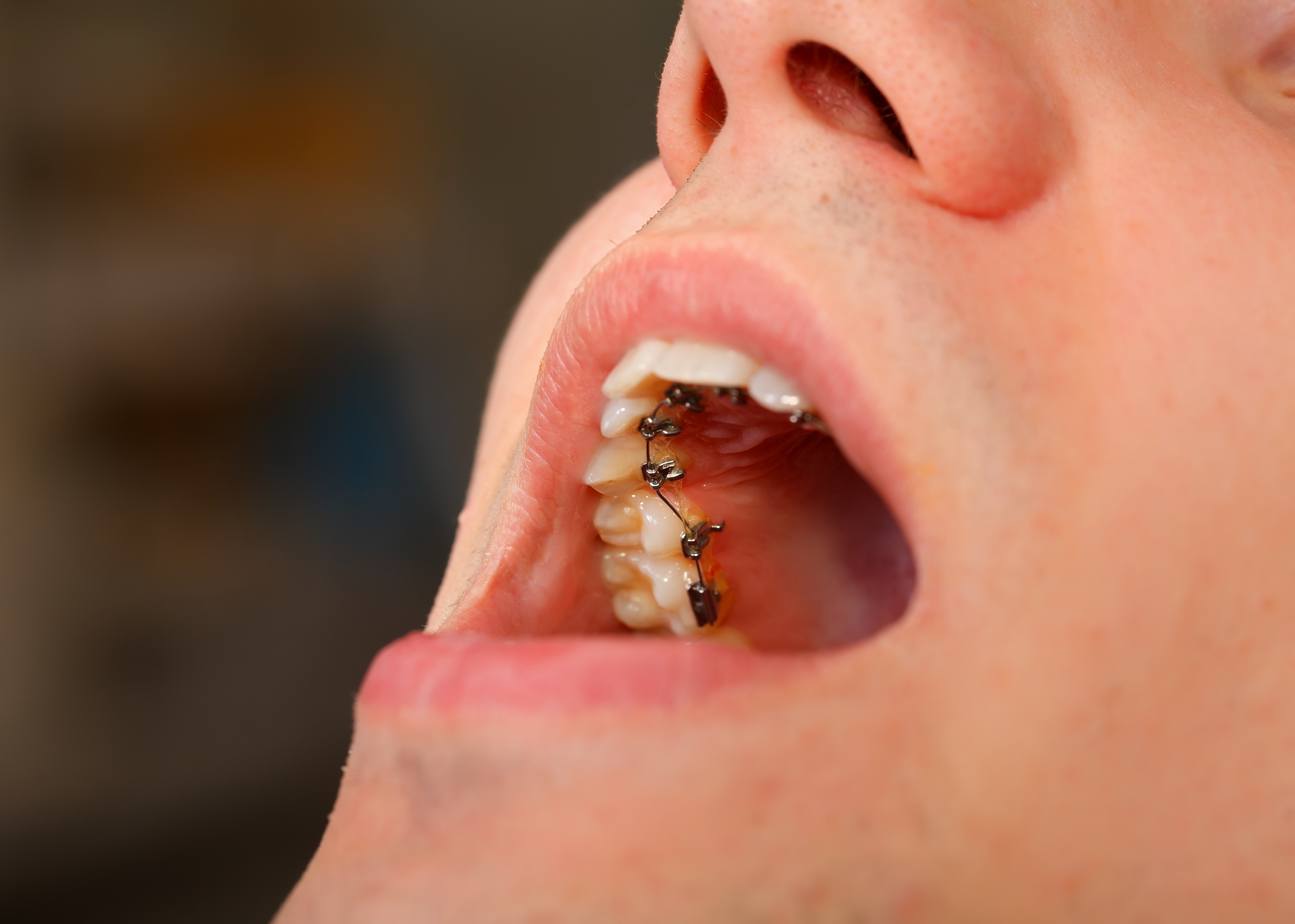 Close-up of open mouth showing teeth with lingual braces on the inner side.