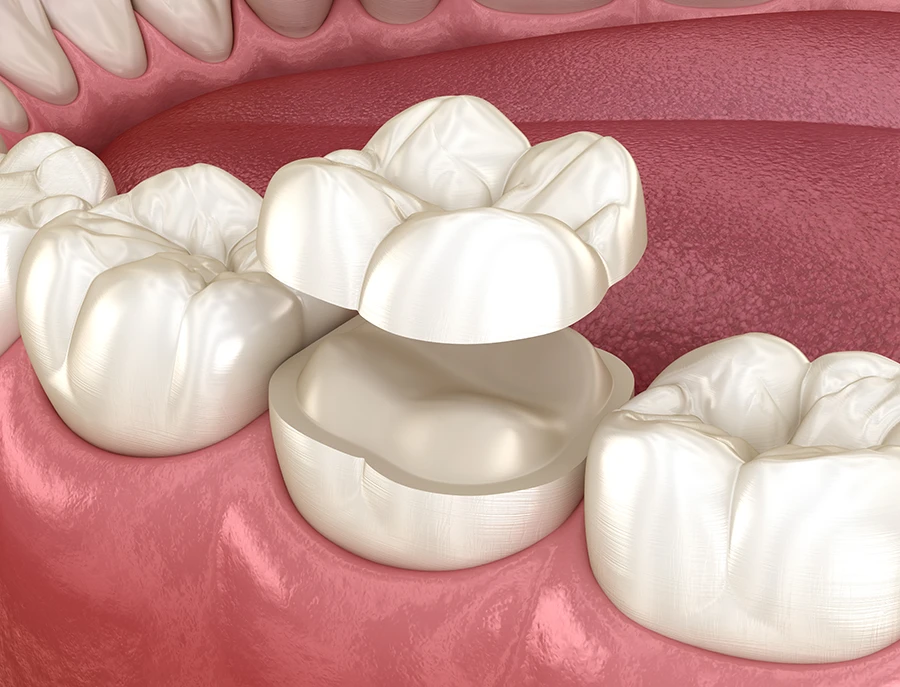 3D dental illustration showing a molar crown being placed over a prepared tooth on pink gums.