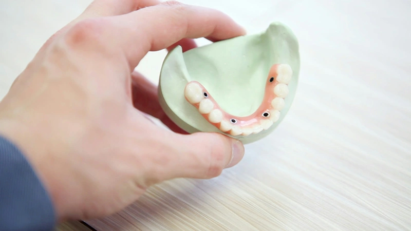 Hand holding a dental mold with a lower jaw dental bridge and replacement teeth.