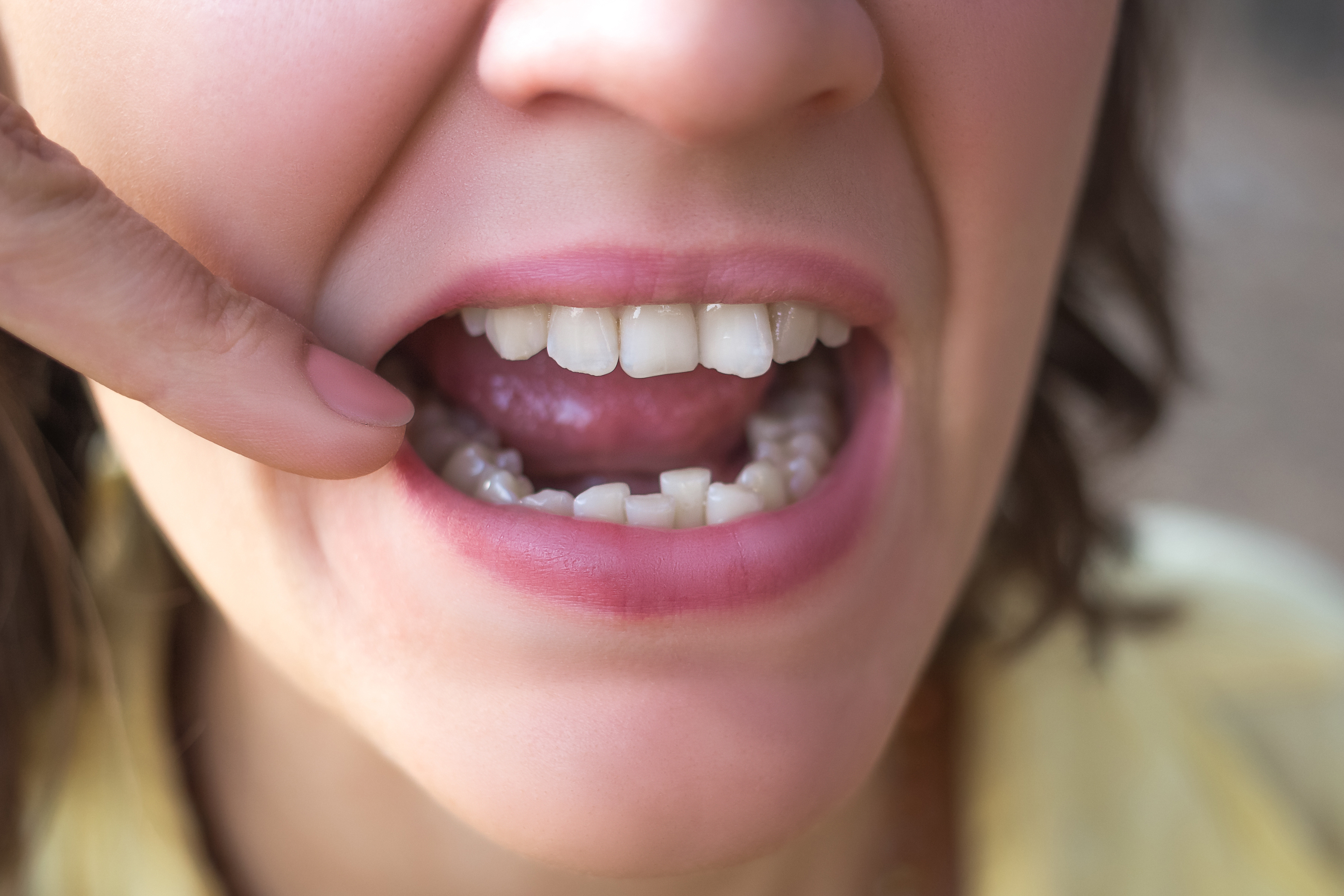 Close-up of a person showing misaligned teeth with a finger pulling down the lower lip.