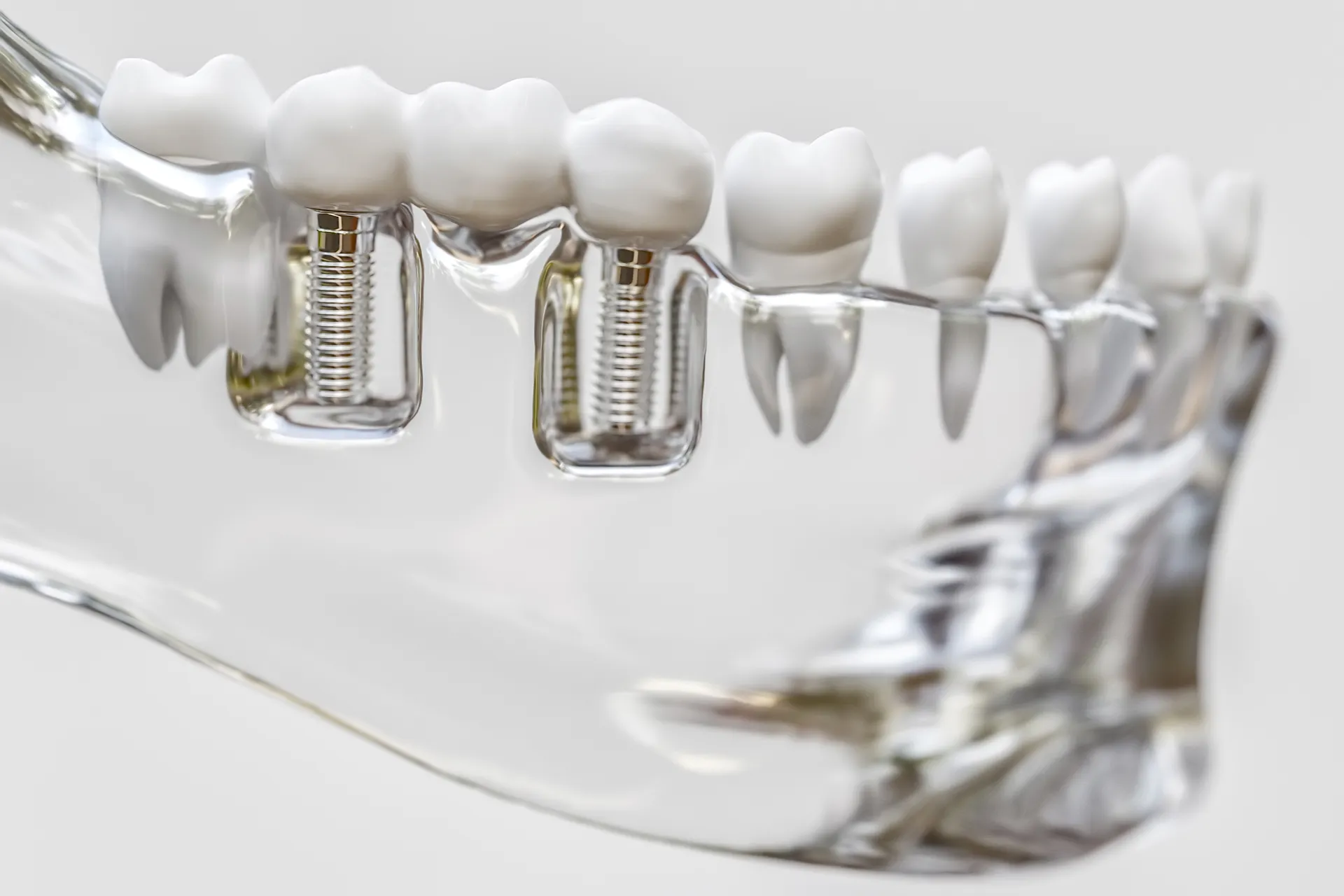 Transparent jaw model showing two dental implants with crowns among natural teeth.