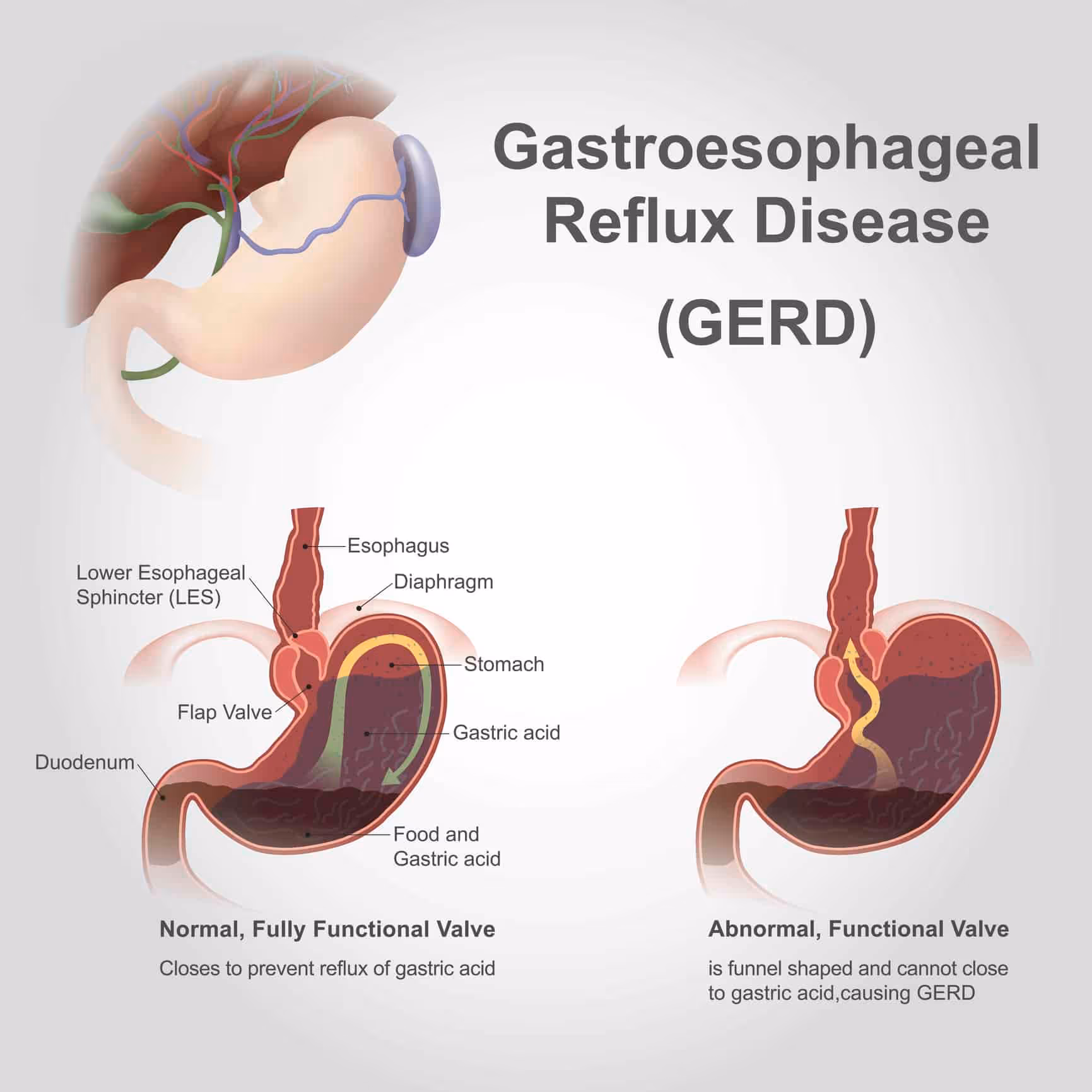 Torax GERD system