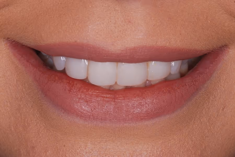 Close-up of a smiling mouth showing clean, white teeth and natural lips.