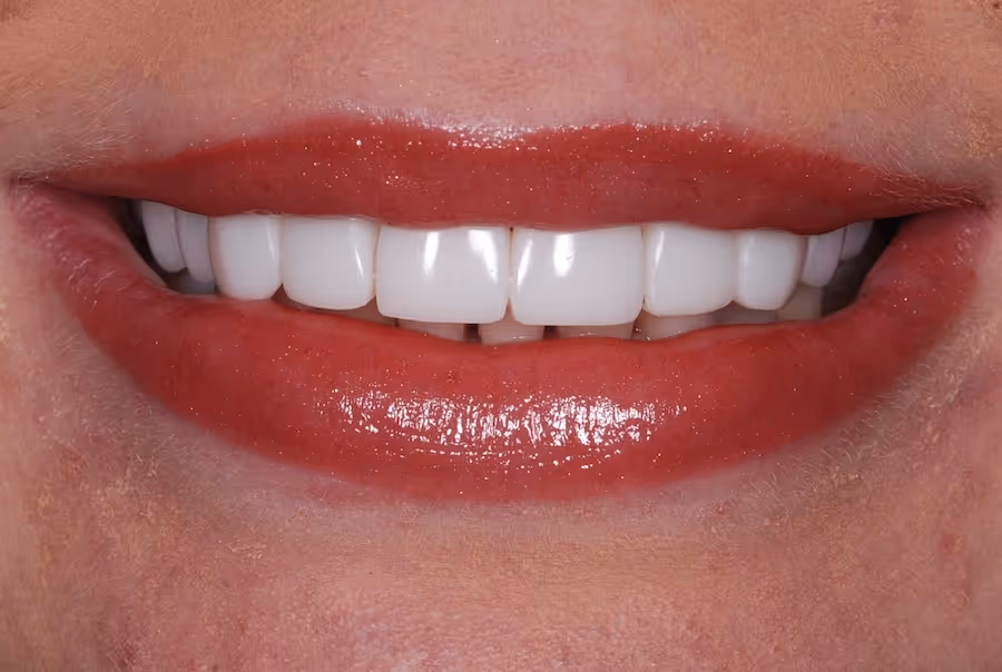 Close-up of a person's mouth smiling with white, evenly shaped teeth and glossy lips.