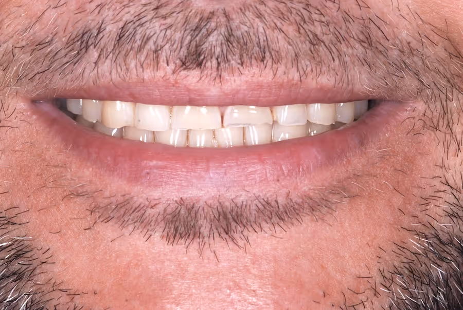 Close-up of a man's mouth smiling showing slightly uneven upper teeth with some discoloration and sparse facial hair around lips and chin.