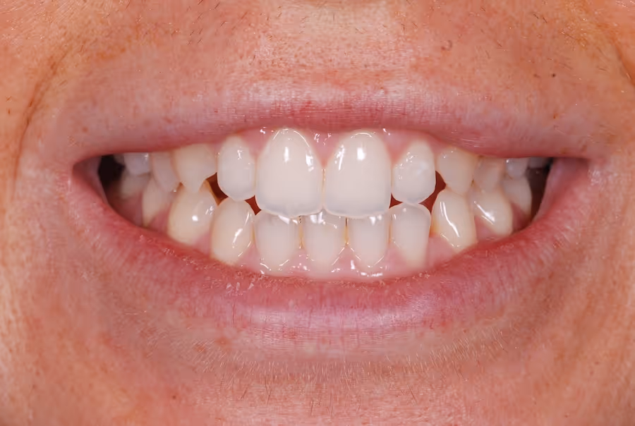 Close-up of a smile showing teeth with visible misalignment and crowding.