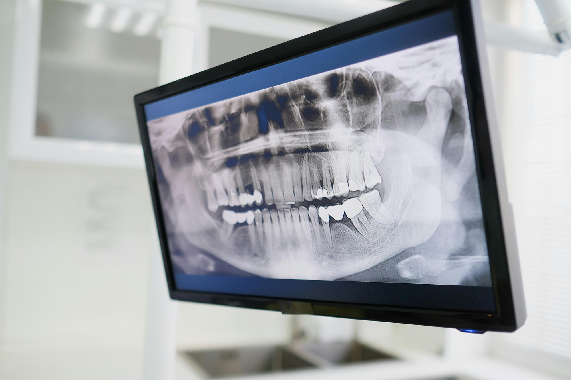 Digital panoramic dental x-ray displayed on a monitor showing teeth and jaw structure.