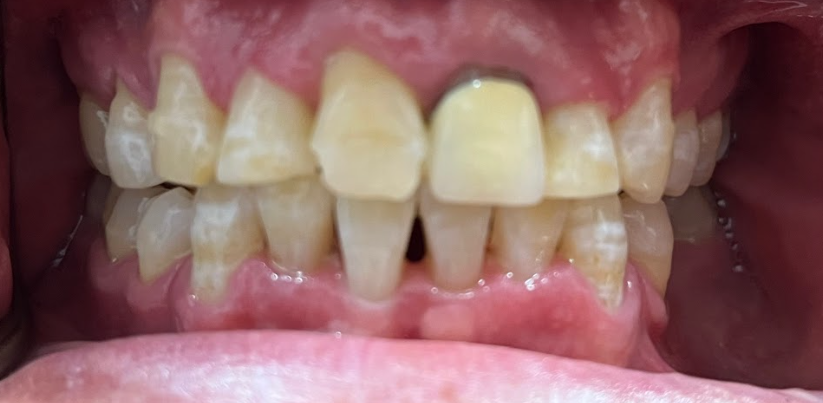 Close-up of a person's teeth showing yellowish discoloration and gaps, with visible teeth irregularities and reddish gums.