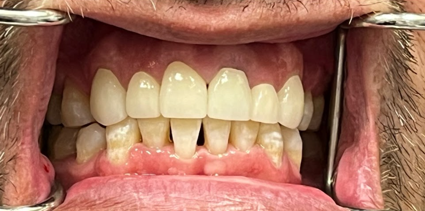 Close-up of a person's mouth showing upper and lower teeth with gaps and discoloration, held open by dental retractors.