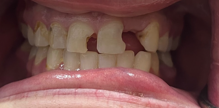 Close-up of a mouth with severely decayed and broken upper front teeth and a partially open lower lip.