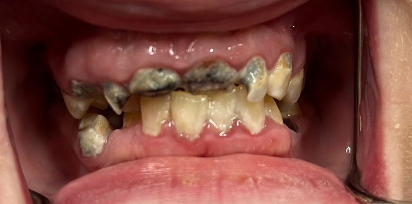 Close-up of a person's mouth showing severely decayed and damaged upper and lower teeth with visible black cavities and gum inflammation.