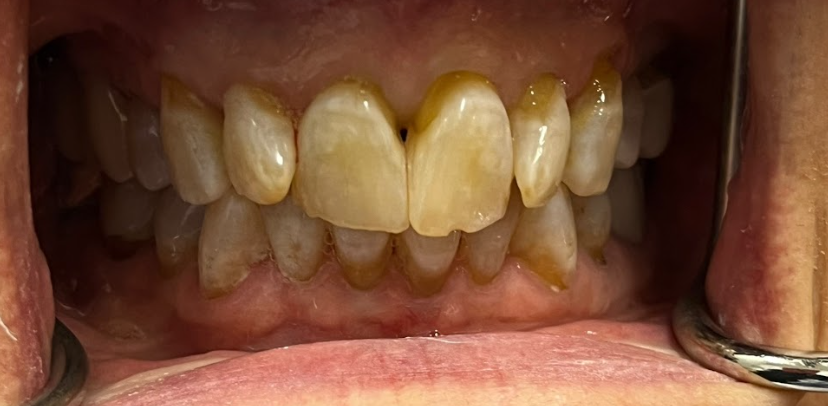 Close-up of stained and discolored upper and lower front teeth with dental retractors in mouth.