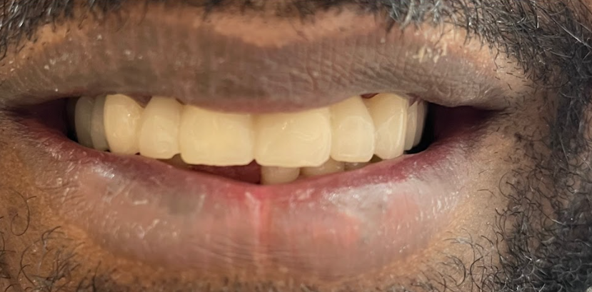 Close-up of a person's partially open mouth showing crooked upper front teeth with a gap and some facial hair around the lips.