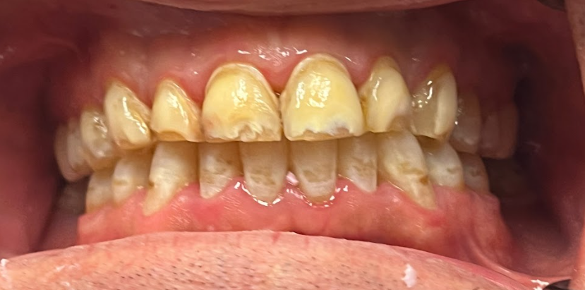 Close-up of upper and lower teeth with visible yellow discoloration and dental plaque.