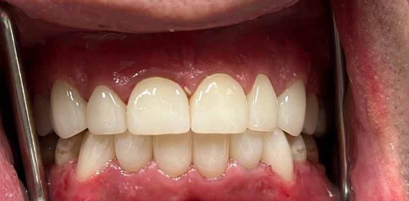 Close-up view of a person's upper and lower front teeth with dental retractors exposing gums and teeth.