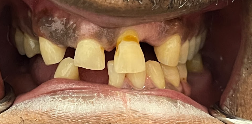 Close-up of an open mouth showing uneven, discolored, and damaged teeth with missing gaps.