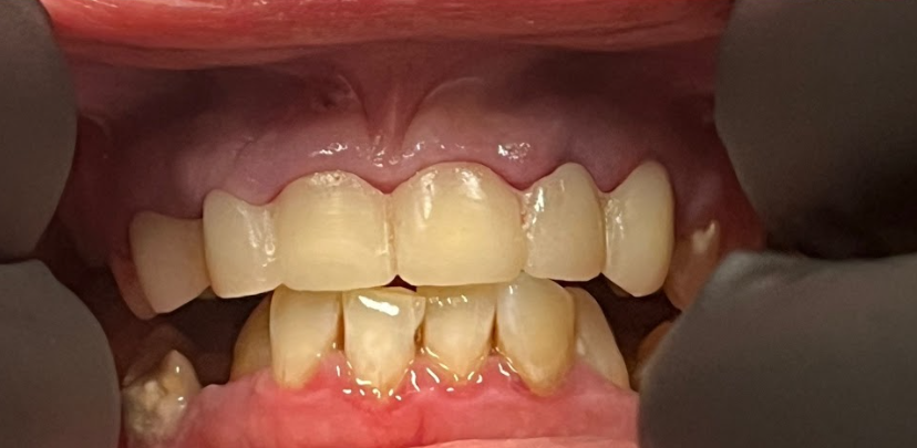 Close-up of a lower and upper set of human teeth with some yellowing and plaque buildup on the lower teeth.