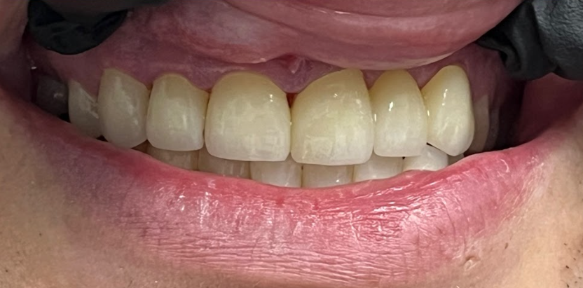 Close-up of a smiling mouth showing upper and lower teeth with natural color and smooth texture.
